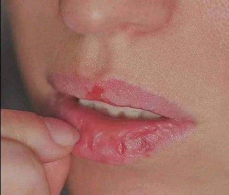 Dry Lips Aesthetic, Blood Wallpaper, Dry Cracked Lips, Lip Trends, Small Lips, Creepypasta Cute, Cracked Lips, Dark Lips, Creative Instagram Photo Ideas