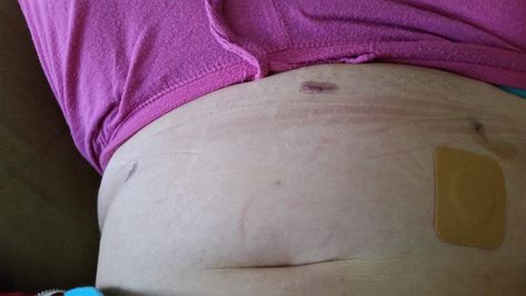 How I healed so fast after surgery and amazed my surgeon Pemf Device, I Healed, Laparoscopic Surgery, Pelvic Pain, After Surgery, Post Surgery, Band Aid, Surgery, I Am Awesome