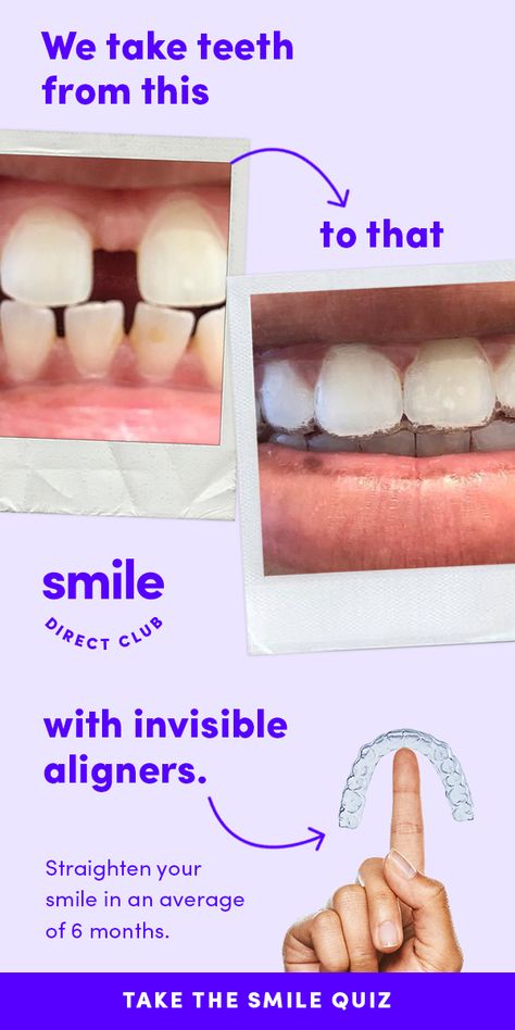 Take the free quiz to see how it works. Get a smile you'll love in an average of 6 months with invisible aligners for just $80/mo. Dental Quiz, Straighten Teeth, Invisible Aligners, Trendy Nails Ideas, Smile Direct, Teeth Straightening, Clear Aligners, Free Quiz, Pixie Styles