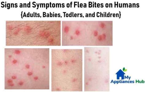 These Are Signs and Symptoms of What Flea Bites on Humans Look Like. Learn What Causes Fleabites and Symptoms When Flea Bites Get Infected Rid Of Fleas In House, Fleas In Yard, Flea Bites On Humans, Fleas In House, Fleas On Kittens, Sand Fleas, Get Rid Of Fleas, Bug Infestation, Human Pictures