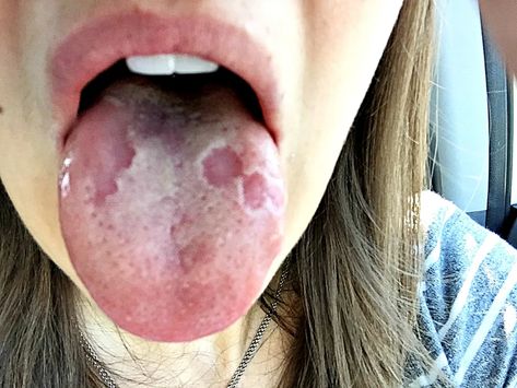 Geographic Tongue (Glossitis) and the Gluten Connection - Good For You Gluten Free Sample Meal Plan, Health Signs, Sans Gluten Sans Lactose, Tongue Health, Free Meal Plans, Nutritional Deficiencies, Gluten Sensitivity, Gluten Free Diet, Oral Hygiene