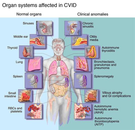 Info regarding how this CVID affects our bodies. Immune Deficiency, Deficiency Diseases, Chronic Sinusitis, Medicine Notes, Organ System, Ehlers Danlos Syndrome, Rare Disease, Autoimmune Disorder, Invisible Illness