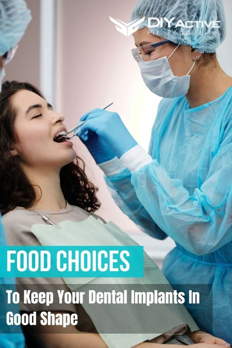 Taking care of your dental implants involves more than regular cleaning and check-ups. Read on for tips on making food choices that help keep your implants in prime condition. Clear Choice Dental Implants, Coclear Implant, Free Dental Implants, Benefits Of Dental Implants, Water Pick, Dental Implant Surgery, Dental Implant Procedure, Calcium Rich Foods, Dental Procedures