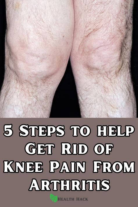 Discover the proven methods to manage and reduce knee pain from arthritis. Start your journey towards a pain-free life now. Arthritic Knee Pain Relief Remedies, Arthritic Knee Pain Relief, Knee Workout, Knee Pain Relief Remedies, Knee Pain Relief Exercises, Knee Health, Knee Strengthening, Bad Knee Workout, Knee Strength