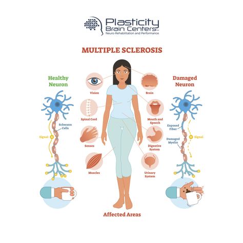 Your brain's own plasticity has the amazing ability to slow or stop the progression of multiple sclerosis with the help of professionals at Plasticity Brain Centers. http://bit.ly/PBCneurodegen Professions, The Amazing, The Help, Brain