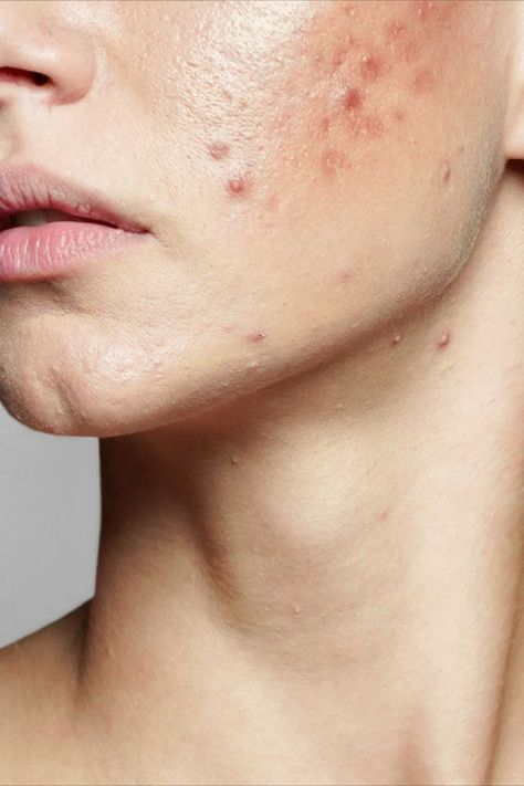 acne Acne Aesthetic, Acne Photos, Skin Breakouts, Stubborn Acne, Remove Skin Tags Naturally, Acne Overnight, Acne Face, Acne Skincare Routine, Natural Acne Remedies