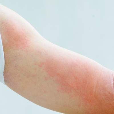 Hiv Symptoms Men, How To Treat Hives, Chronic Hives, Hiv Symptoms, Chronic Idiopathic Hives, People With Hiv, Itchy Rash, Medical Terms, Dermatology