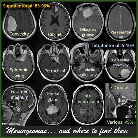 Home / Twitter Brain Radiology, Neuro Interventional Radiology, Neurodiagnostic Technologist, Brain Mri, Diagnostic Radiography, Brain Tumour Ct Scan, Medical Radiography, Radiology Student, Radiology Imaging