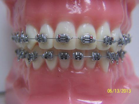 Brackets Ideas, Braces Journey, Braces Care, Silver Braces, Dental Health Kindergarten, Braces Bands, Kids Dental Health, Adult Braces, Getting Braces