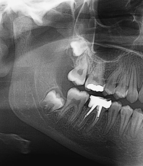 Pulpitis article Dental Xrays, Dental Infection, Tooth Infection, Gum Inflammation, Discolored Teeth, Gum Recession, Tooth Pain, Science Photos, Sinus Infection