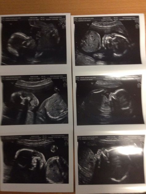 20 week Scan 20 Week Ultrasound, 3d Ultrasound Pictures, Baby Ultrasound Pictures, 20 Week Scan, 3d Ultrasound, 4d Ultrasound, Baby Ultrasound, Ultrasound Pictures, Baby Scan