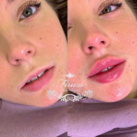 Nose Job And Lip Fillers, 1ml Of Lip Filler, Lip Fillers On Small Lips, Lip Injections Natural, Lip Fillers 2ml, Lip Injection Inspiration, Russian Style Lip Fillers, Lip Filler Round Lips, 1.5 Ml Lip Filler