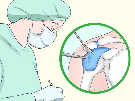 3 Ways to Treat Shoulder Tendonitis - wikiHow Shoulder Tendinosis, Shoulder Tendinosis Exercises, Achilles Pain, Lower Extremity, Thigh Muscles, Poor Posture, Hip Pain, Calf Muscles, School Of Medicine