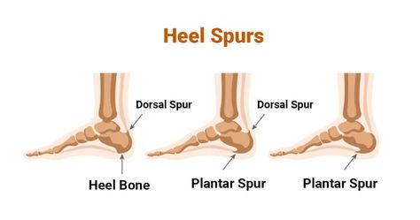 calcaneal spur Calcaneal Spur, Heel Spur, Calcium Deposits, Ligaments And Tendons, Physical Activity, Physical Therapy, Bones, Heels, Quick Saves