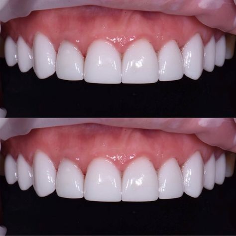 Naturally Whiten Teeth, Pretty Teeth, Get Whiter Teeth, Veneers Teeth, Beautiful Teeth, Cute Tooth, Dental Design, Porcelain Veneers, Perfect Teeth