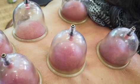 Chinese Cupping, Benefits Of Cupping, Matcha Benefits, Coconut Health Benefits, Cupping Therapy, Benefits Of Coconut Oil, Trigger Points, Medical Practice, Matcha Green Tea