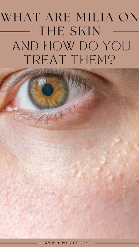 If you've ever seen small, white bumps on your skin, you may be dealing with milia. Milia are different than whiteheads and acne. They are very common, typically not harmful, and can happen to anyone at any age. But what exactly are they? We'll cover common causes of milia and ways to prevent and treat them. White Pimples On Face, White Bumps On Skin, Skin Bumps On Face, White Bumps On Face, Small Bumps On Face, Head Pimples, Bumps Under Eyes, Forehead Bumps, Pimples On Forehead