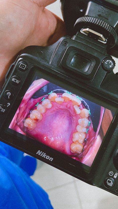 Nikon de330, tooth picture, tooth extraction, orthodontics, dentistry life, asthetic denstistry Tooth Picture, Dental Extraction, Dental Photography, Tooth Extraction, Nikon, Photography