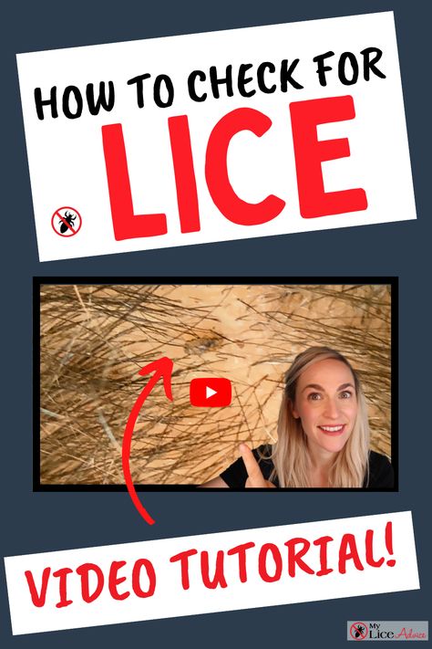 Lice Removal Videos, How To Treat Lice At Home, Natural Remedies For Lice, How To Get Rid Of Lice And Nits Fast, Best Way To Get Rid Of Lice And Nits, Lice Nits, Lice Remedies, Hair Lice, Lice Eggs