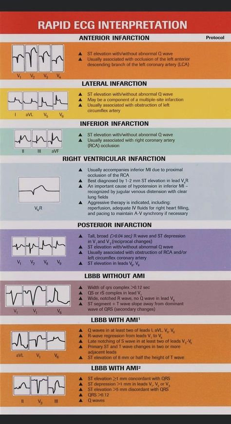 Rapid ECG Interpretation #medicalschool #resources #medicalstudent - Image Credits: Ashley DeTuncq Learn Ekg Cheat Sheets, Cardiac Perfusion Technology, Echocardiography Study, Acls Study Guide 2022, Cardiovascular Nursing, Skills For Resume, Cvicu Nursing, Nurse Skills, Ekg Interpretation