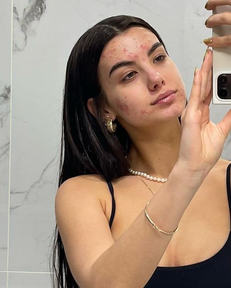 Girl With Acne, Celebrity Acne, Pele Natural, Natural Face Skin Care, Get Rid Of Acne, Rid Of Acne, Face Acne, Healthy Skin Tips, Facial Skin Care Routine