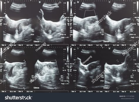 Ultrasound image of lower abdomen, ovary and uterus with tumor or uterine fibroid, leiomyoma of female woman patient for gynecological medical exam, analysis and testtumor#uterus#fibroid#uterine Postpartum Hemorrhage, Fibroid Uterus, Radiology Imaging, Medicine Notes, Ultrasound Tech, Lower Abdomen, Radiology, Healthy Pregnancy, Emergency Medical