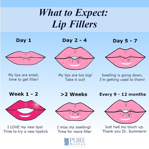 Lip Filler, Radiate Confidence, Lip Fillers, Price Comparison, Pros And Cons, Different Types, Budgeting, Every Day