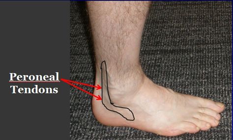 Location of pain and swelling in Peroneal Tendonitis Peroneal Tendon, Peroneus Longus, Achilles Pain, Ankle Ligaments, Ankle Surgery, Ligament Tear, Swollen Ankles, Achilles Tendon, Kinesio Taping