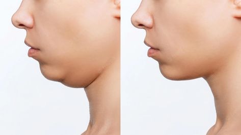 Premium Photo | Liposuction of double chin cropped shot of woman's face with chin before and after plastic surgery Double Chin Before And After, Double Chin Reduction, Herbal Medicine Recipes, Unwanted Hair Growth, Baby Feeding Schedule, Polycystic Ovaries, Receding Gums, Prom Hairstyles For Long Hair, Pregnancy Health