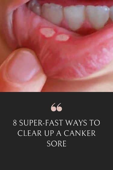 8 Super-Fast Ways To Clear Up A Canker Sore Sore In Mouth Remedies, Canker Sore Causes, Gum Sores, Canker Sore Relief, Ulcer Remedies Mouth, Canker Sore Remedy, Sore Lips, Mouth Rinse, Canker Sore