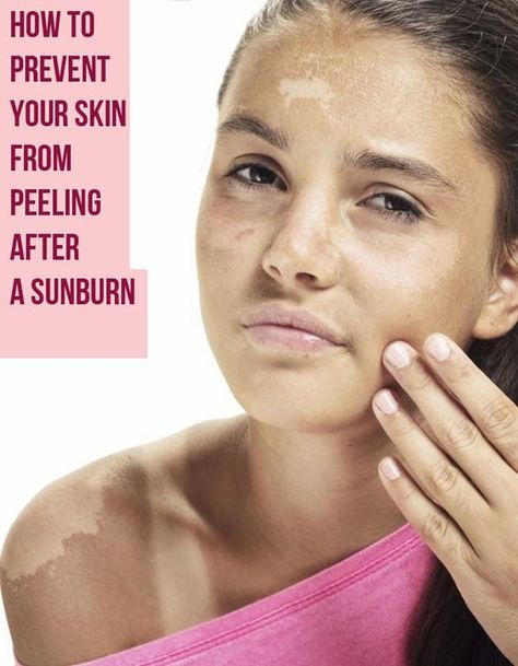 How to Prevent Your Skin From Peeling After a Sunburn: Sunburn Peeling, Combination Skin Face Wash, Workout Smoothies, Skin Burns, Health Topics, Perfect Skin Care Routine, Natural Teeth Whitening, Cold Sore, Peeling Skin