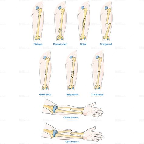 Compound Fracture, Open Fracture, Scientific Illustration, Nursing, Science, Quick Saves