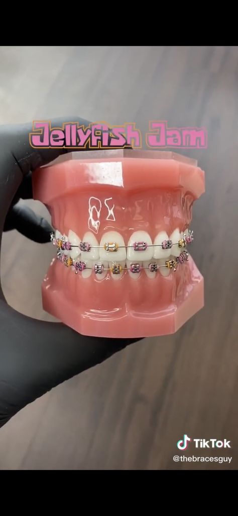 The Braces Guy, Braces Guy, Brace Colors, Braces Aesthetic, Braces Colours, Dental Braces Colors, Braces Colors Combinations, Braces Ideas, Pink Braces