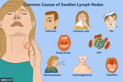 Home Remedies For Bronchitis, Lymph Node, Dental Infection, Lymph Glands, Foot Reflexology Massage, Throat Infection, Strep Throat, Foot Reflexology, Chicken Dip