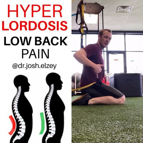 Dr. Josh Elzey PT, DPT on Instagram: “Lordosis refers to the natural curve of the lumbar spine (low back). - HYPER Lordosis refers to an EXCESSIVE or greater than “normal”…” Lumbar Lordosis, Lumbar Spine, Low Back Pain, Natural Curves, Greater Than, The Natural, Low Back, Back Pain, Tv