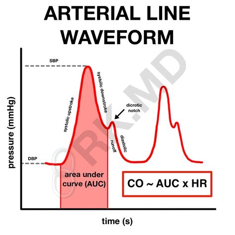 Pressure Transducers And Arterial Line Waveforms | RK.MD Central Venous Pressure, Arterial Line, Mean Arterial Pressure, Wheatstone Bridge, Septic Shock, Intracranial Pressure, Blood Pressure Cuff, Intensive Care Unit, Intensive Care