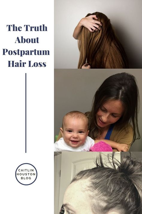 The truth about postpartum hair loss Postnatal Haircut, Postpartum Hairloss Hairstyle, Postpartum Hair Shedding, Post Partum Hairloss Hairstyles, Postpartum Hairstyles, Postpartum Haircut, Postpartum Hair Regrowth, Postpartum Advice, Alopecia Causes