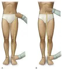 Leg Length Discrepancy, Psoas Muscle, Length Measurement, Measurement Length, Physical Therapy