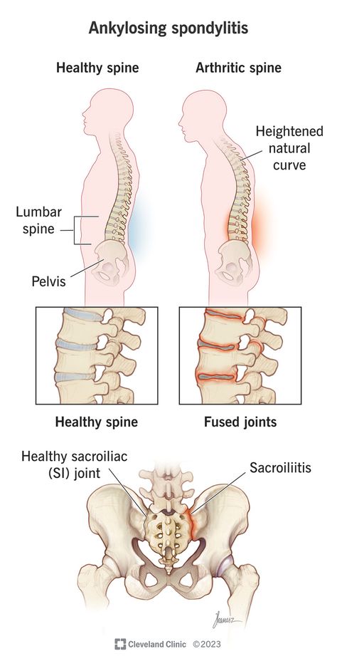 What Is Ankylosing Spondylitis? Higher Art, Healing Thoughts, Skeletal System, Vision Problems, Medical Knowledge, Low Back Pain, Medical Information, Skeletal, Autoimmune Disease