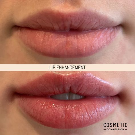 Heavy Upper Lip, Lip Enhancement, Upper Lip, Dermal Fillers, Lip Fillers, It Works, Lips, Take That, 10 Things