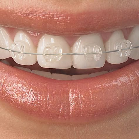 Damon clear braces My braces are going to be these !! Excited ready for #straightprettyteeth Clear Braces Ceramics, Sapphire Braces, Braces For Teeth, Braces Clear, Damon Braces, Braces Smile, Ceramic Braces, Types Of Braces, Adult Braces