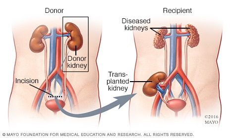 Living-donor kidney transplant - Type - Mayo Clinic Living Kidney Donor, Kidney Donation, Polycystic Kidneys, Kidney Donor, Arteries And Veins, Healthy Kidneys, Kidney Damage, Disease, Medical