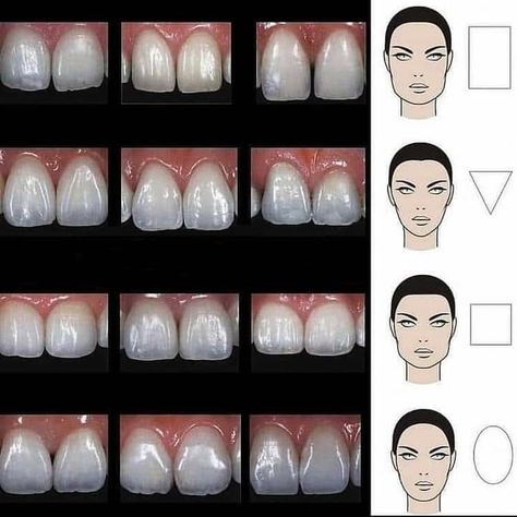 Prosthodontics Dentistry, Dental Lab Technician, Dental Ceramics, Esthetic Dentistry, Dental Photos, Dental Aesthetics, Dental Videos, Kesehatan Gigi, Dental Photography