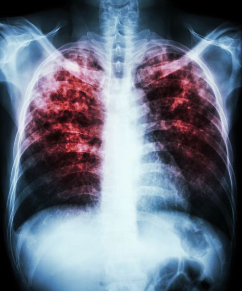 A new report by the World Health Organization (WHO) shows how a preventable, curable disease has become the world’s biggest communicable killer. (1) Tuberculosis (TB) now surpasses HIV/AIDS in the number of lives it claims. Enlarged Heart, Persistent Cough, Too Much Estrogen, Hard Breathing, Chronic Obstructive Pulmonary Disease, Pulmonary Disease, Lung Disease, Lungs, Image Hd