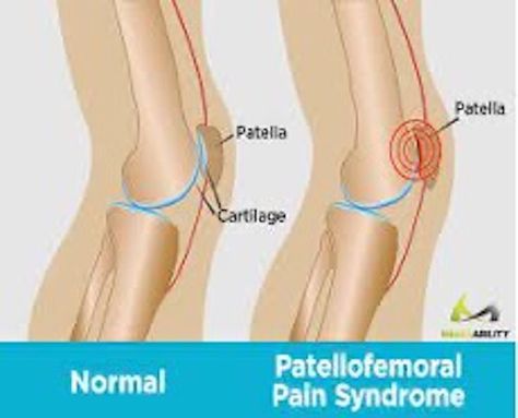 Knee pain caused by abnormal alignment of the patella in the femoral groove. Exercises to help rehab and prevent from occurring. Patellofemoral Pain Syndrome Exercises, Knee Pain Stretches, Lower Back Pain Stretches, Patellofemoral Pain Syndrome, Back Pain Stretches, Inner Knee Pain, My Knee Hurts, Swollen Knee, Knee Pain Exercises