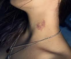 hickey Photo Hickey, Aesthetics Hickeys, Hickies Neck Aesthetic Girl, Hickies Neck Aesthetic, Hickies Neck, Neck Aesthetic, Hot Spring, Couples Goals, Cosmetology