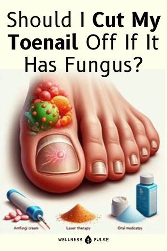 Learn about the time frame needed for hydrogen peroxide to eradicate toenail fungus. Visit our website for detailed insights and guidance. Toenail Fungus Soak, Nail Health Signs, Nail Info, Toenail Care, Homemade Nail Polish, Toenail Health, Toenail Fungal Infection, Nail Remedies, Fingernail Fungus