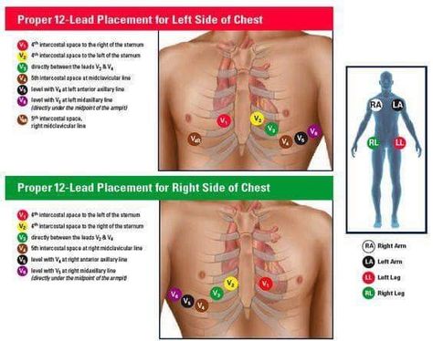 12 lead placement 12 Lead Ekg Placement, Ekg Placement, Ecg Placement, Lead Placement, Medical Assistant School, Emt Study, Nursing Labs, Cardiology Nursing, Nurse Skills