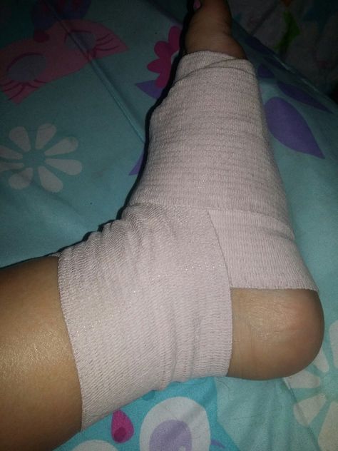 My foot😢😢😢😢😢😢 Ankle Injury Prank, Leg Accident Real Pic For Women, Leg Accident Real Pic In Hospital, Leg Bandage Snap, Leg Injured Images, Fake Injury Leg Snapchat, Leg Injury In The Hospital, Leg Swelling Snapchat, Leg Fracture Snapchat Story