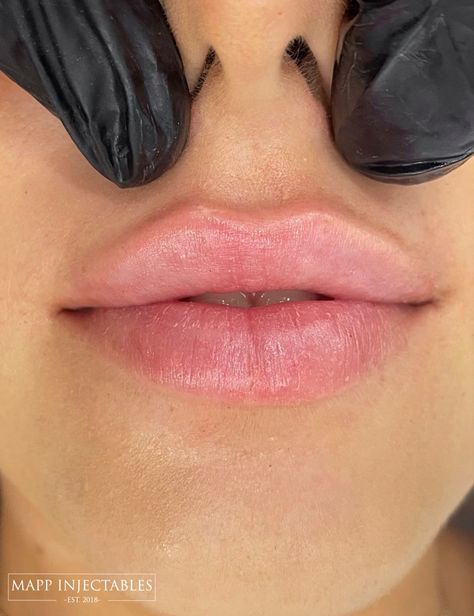 Remove Upper Lip Hair Naturally, Remove Upper Lip Hair, Lip Job, Dermal Fillers Lips, Lip Surgery, Lip Types, Lips Inspiration, Upper Lip Hair, Botox Lips